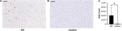 Genetic and Molecular Evaluation of SQSTM1/p62 on the Neuropathologies of Alzheimer’s Disease